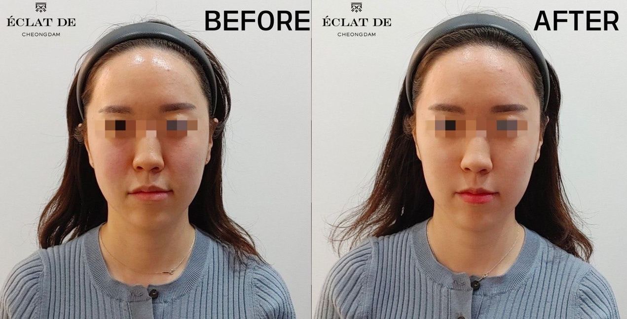 Front Cheek, Under-Eye, and Smile Line Filler-Before & After from Eclat De