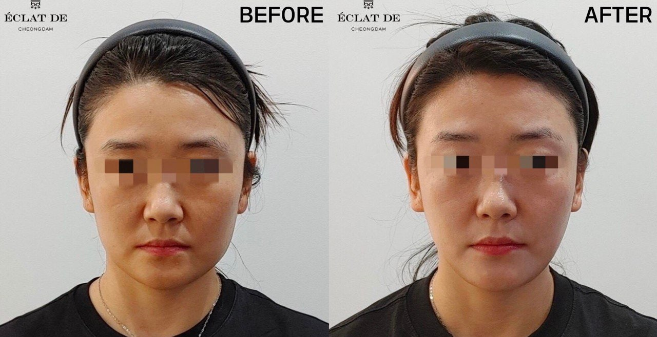 ONDA Lifting 50KJ - Before and After from Eclat De