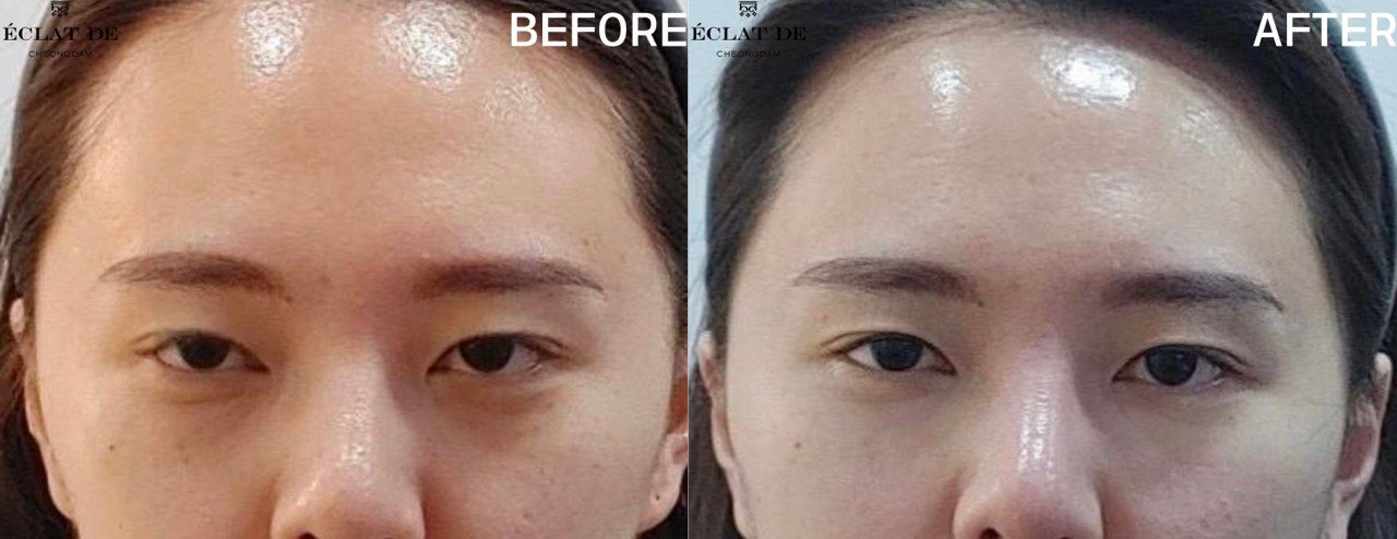 Under-Eye ULTRACOL - Before and After from Eclat De