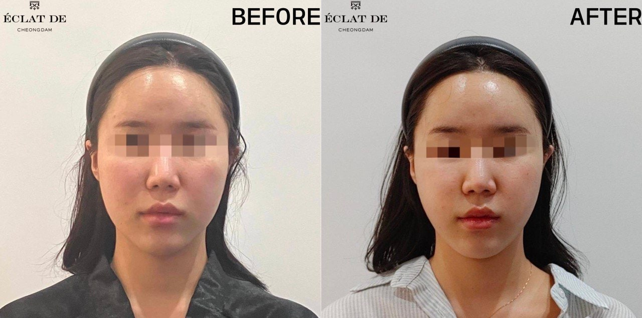 Oligio  300 shots  – Before & After from Eclat De