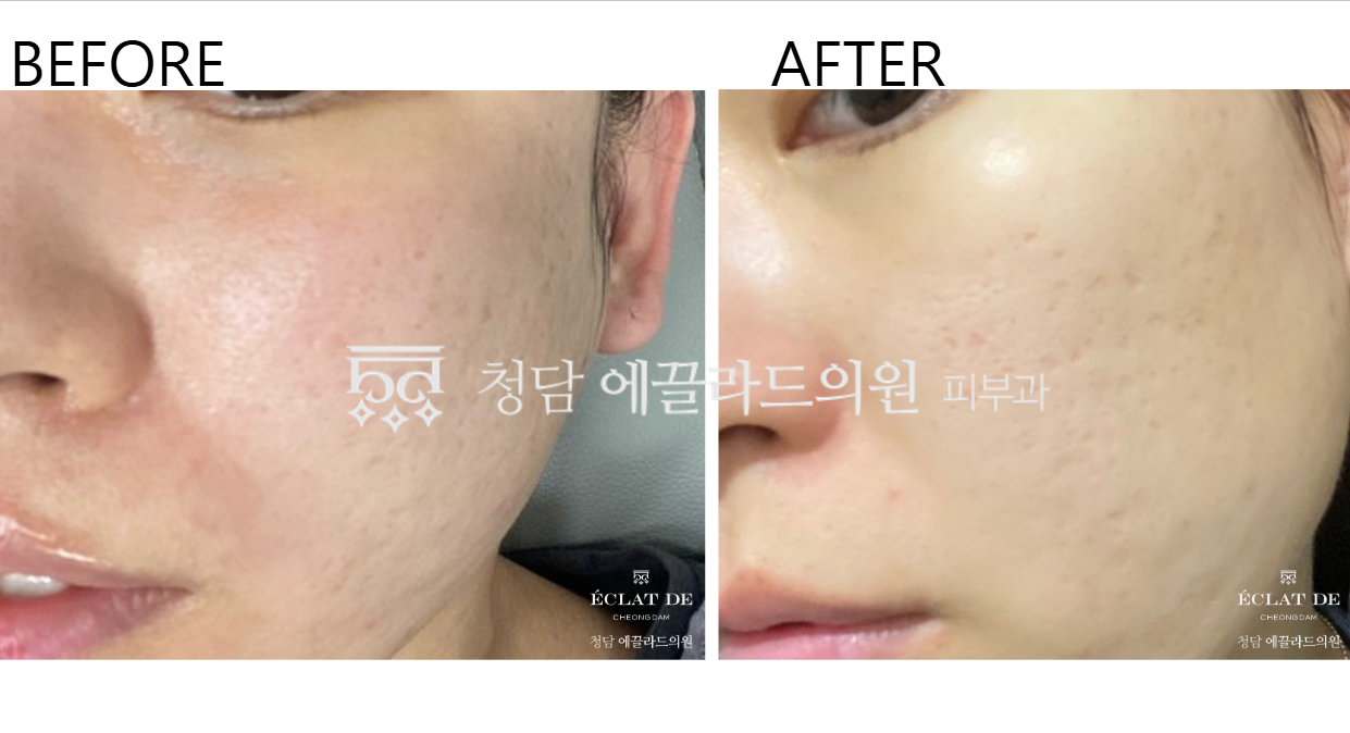 Ellisys Sense – Before & After from Eclat De