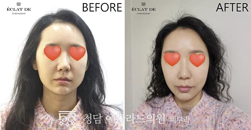 Juvelook Volume- Before & After from Eclat de