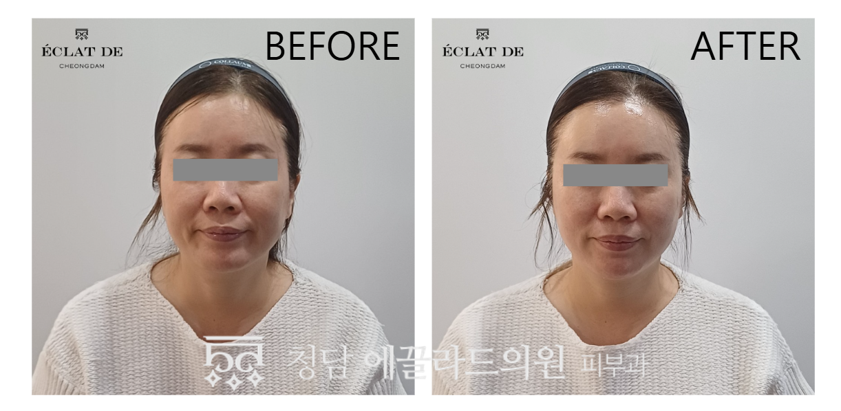 Titanium Lifting 80KJ – Before & After from Eclat De