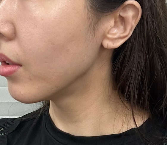 Ultherapy 300 Shots Review