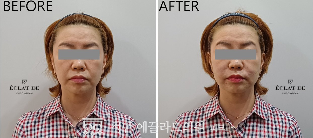 Radiesse  – Before & After from Eclat De