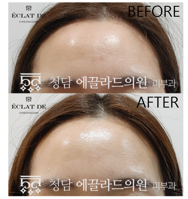 Rejuran – Before & After from Eclat De