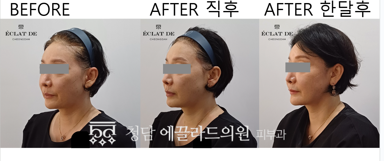 Titanium Lifting 80KJ – Before & After from Eclat De