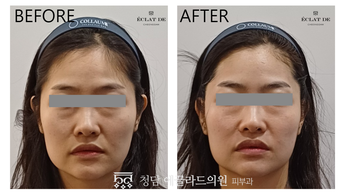 Juvelook Skin – Before & After from Eclat De