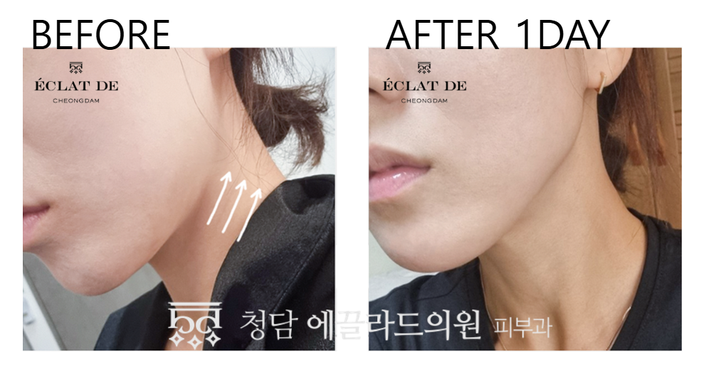 Ultherapy Prime – Before & After from Eclat De