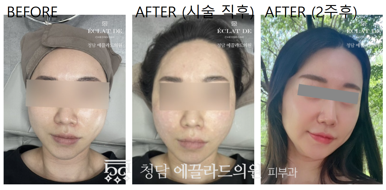 Skin Botox- Before & After from Eclat De