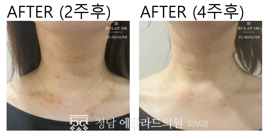 Neck ClearCell + Air Dissector- Before & After from Eclat De