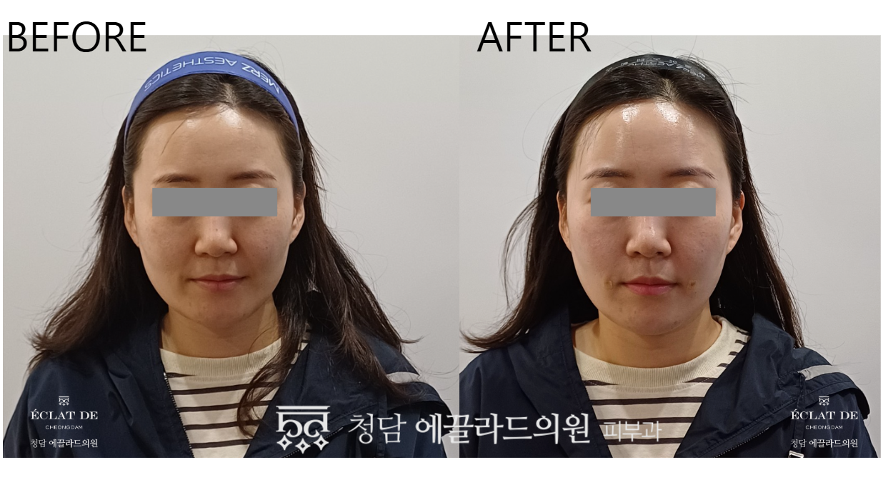 Juvelook Volume- Before & After from Eclat de