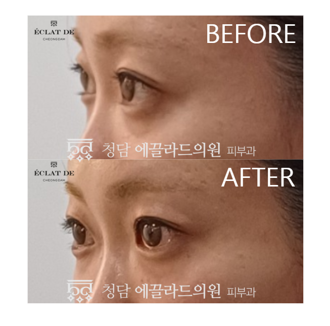 EYE Oligio X – Before & After from Eclat De