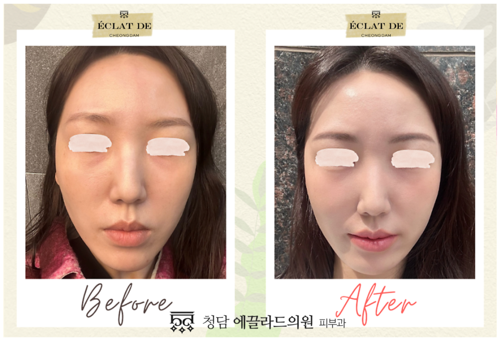 Ultracol 200 – Before & After from Eclat De