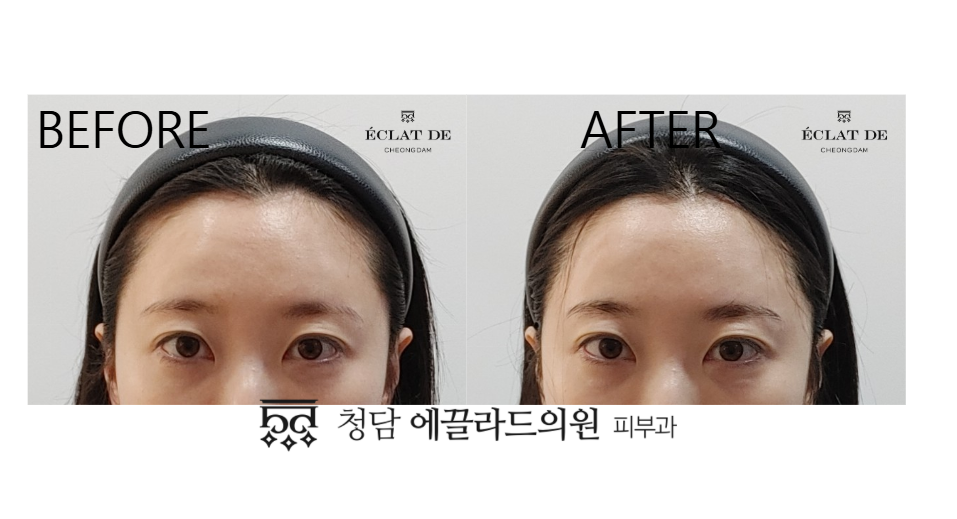 Eye Ulthera- Before & After from Eclat De