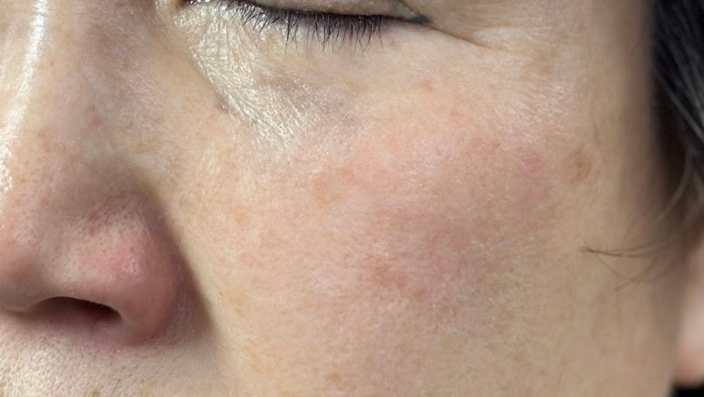  Mom’s Honest Experience Treating Under-Eye Pigmentation & Dark Spots