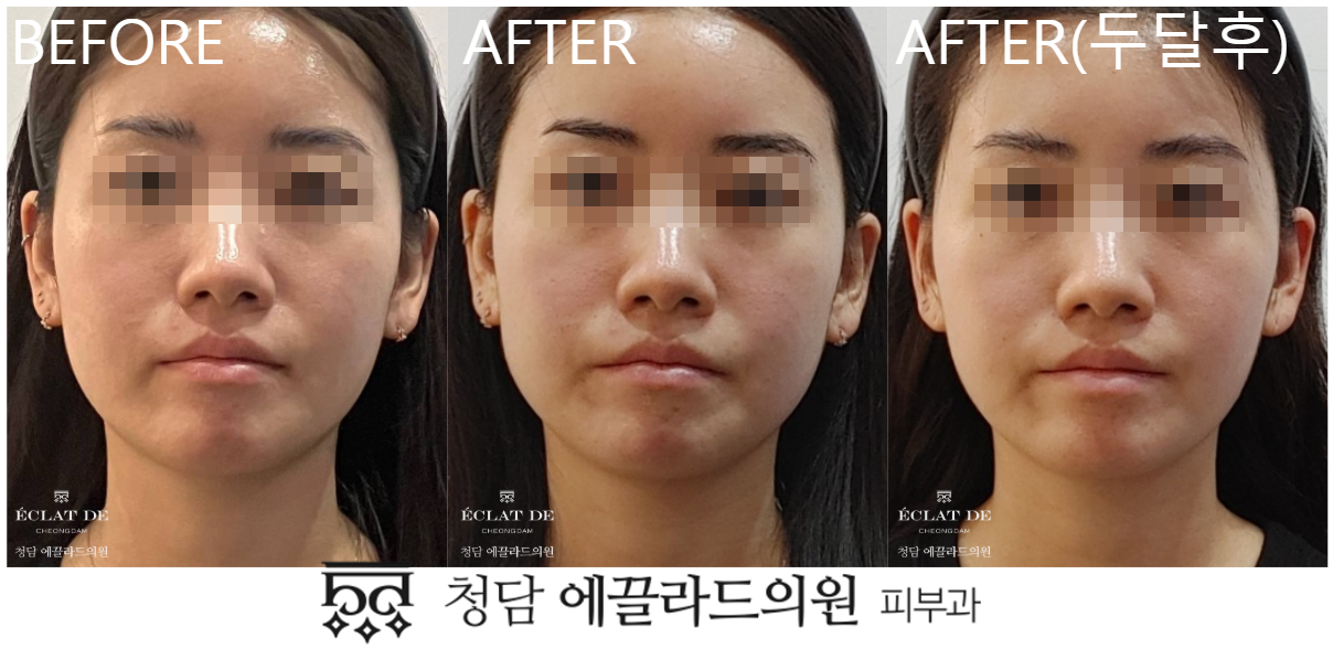 Ulthera + Chin Botox- Before & After from Eclat De