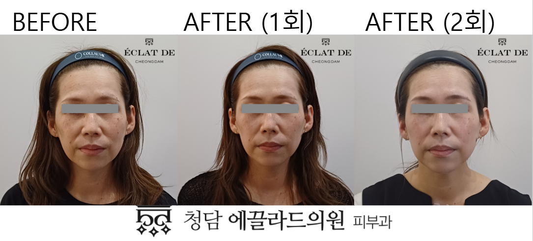 Oligio + Dual Toning – Before & After from Eclat De