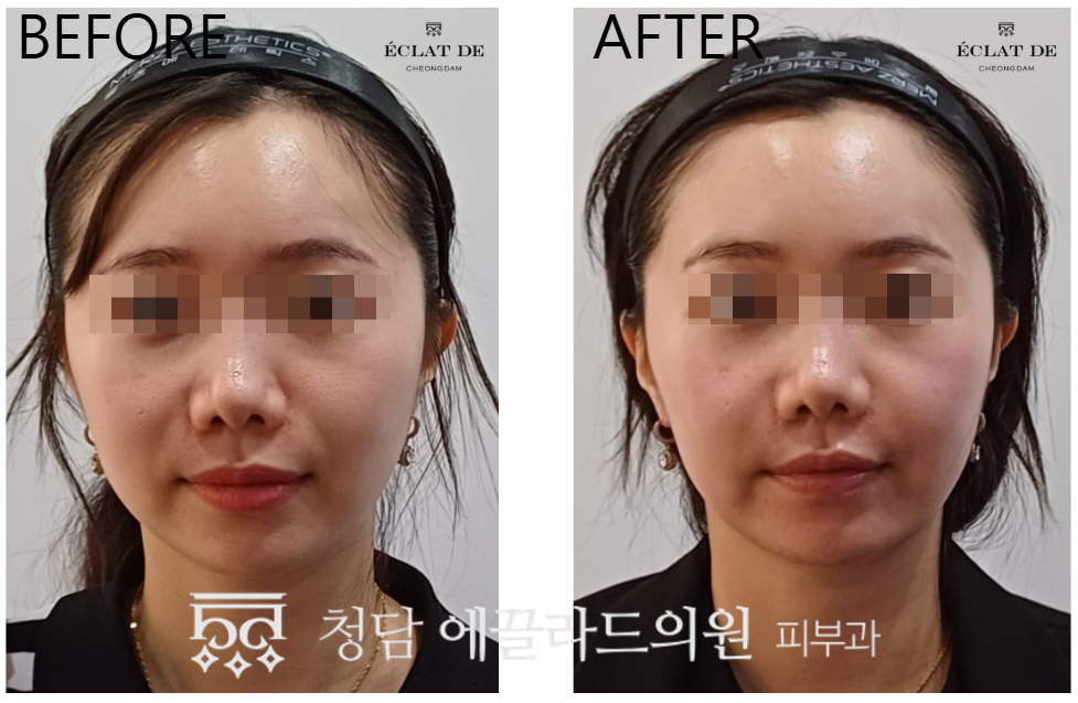 Oligio 300 shots – Before & After from Eclat De