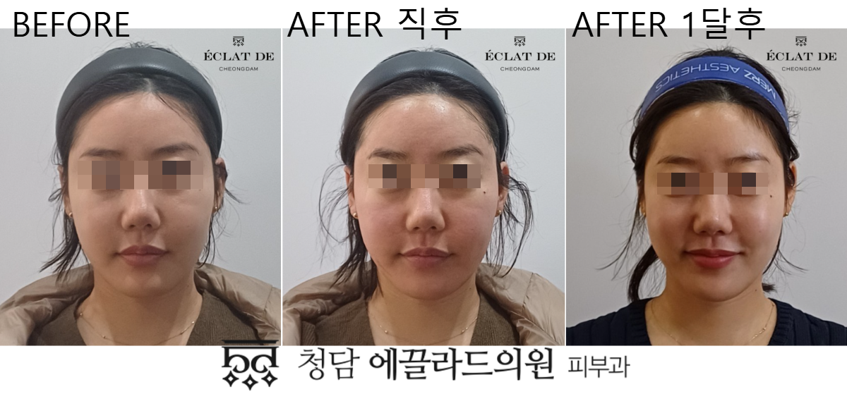 UltraClear- Before & After from Eclat De