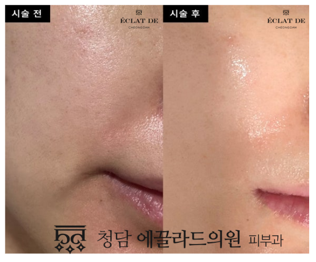 Skin Botox (Xeomin)- Before & After from Eclat De