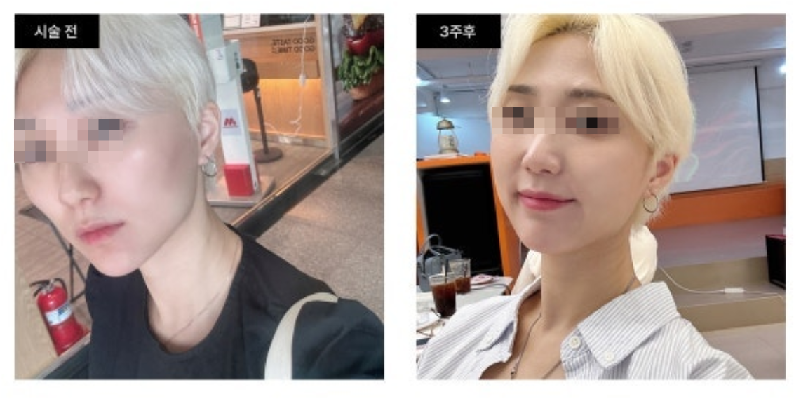 Juvelook Volume Cheek Enhancement- Before & After from Eclat De