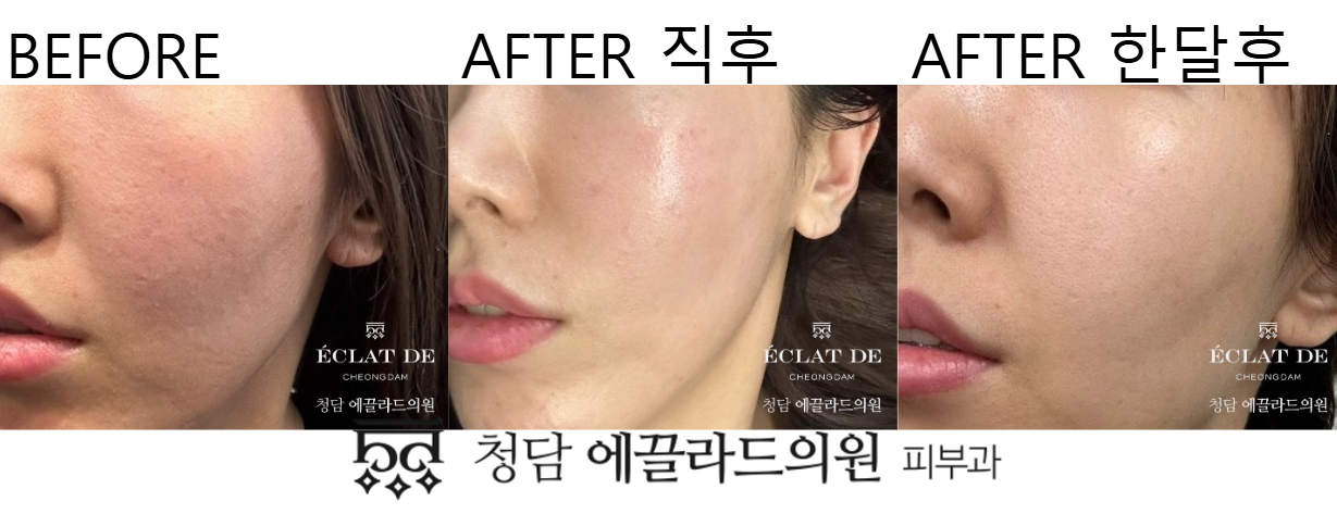 Thermage FLX 300 Shots- Before & After from Eclat De
