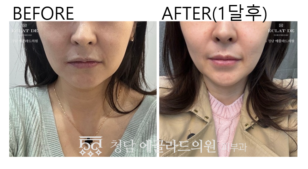 Ulthera 300 shots – Before & After from Eclat De