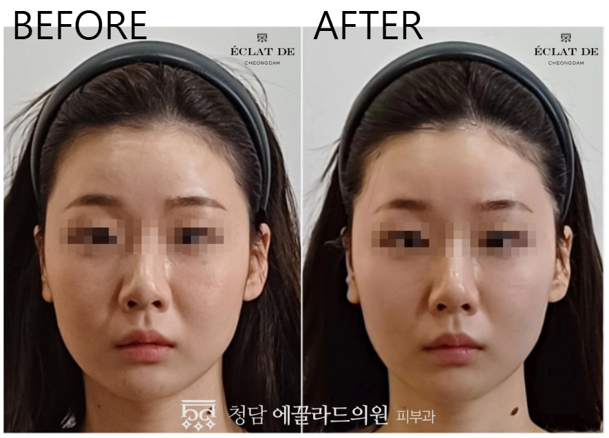 ONDA FACE- Before & After from Eclat de
