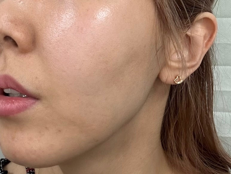 Ultherapy 300 Shots with Sedation