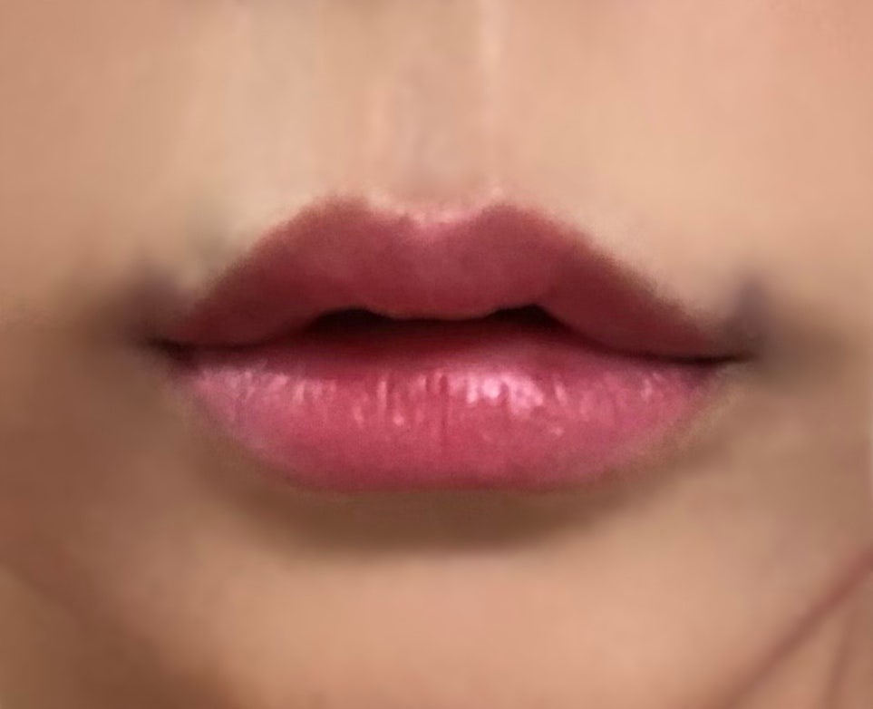My First Lip Filler Experience