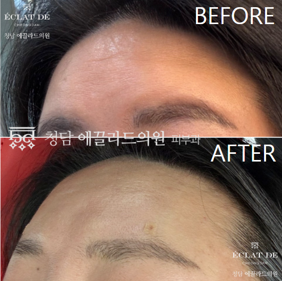 Forehead Filler, Forehead Botox, and Glabella Botox- Before & After from Eclat de