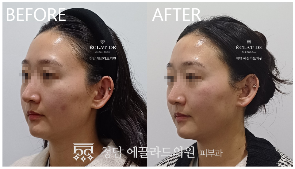 Geneo X- Before and After from Eclat De