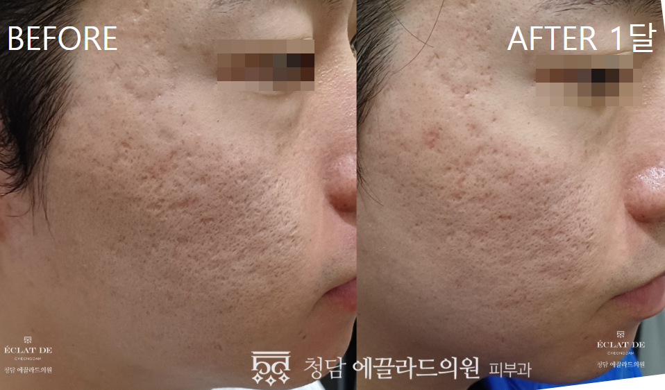 UltraClear- Before & After from Eclat De