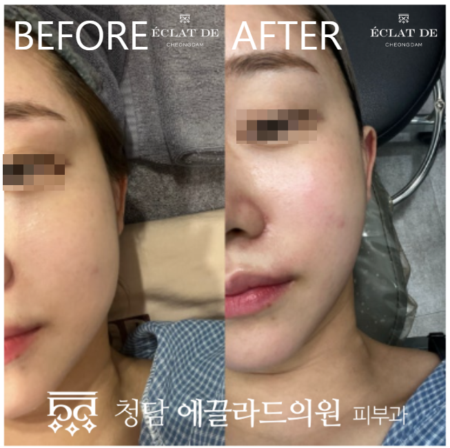 ONDA FACE- Before & After from Eclat de