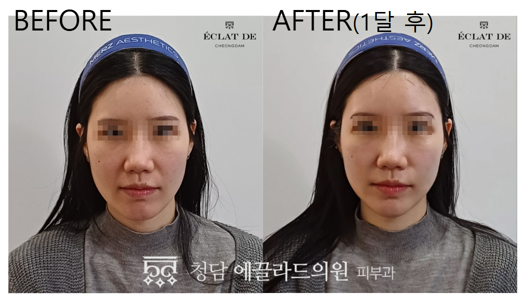 Titanium Lifting 80KJ – Before & After from Eclat De