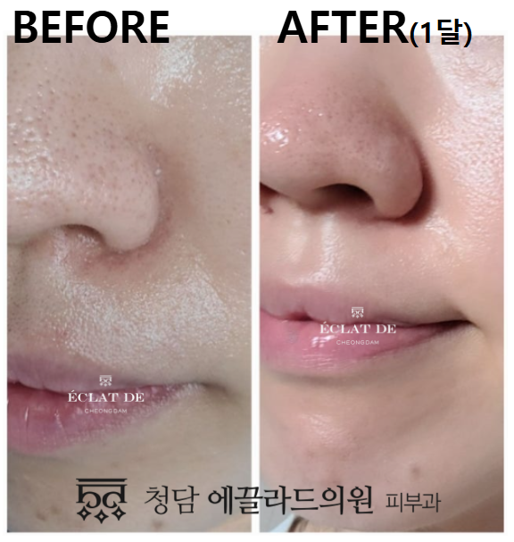 UltraClear- Before & After from Eclat De