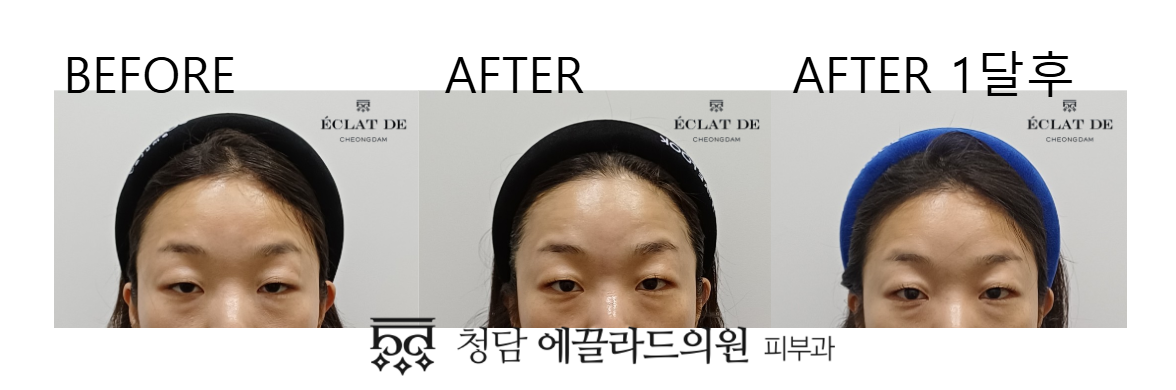 Forehead Shurink- Before & After from Eclat De