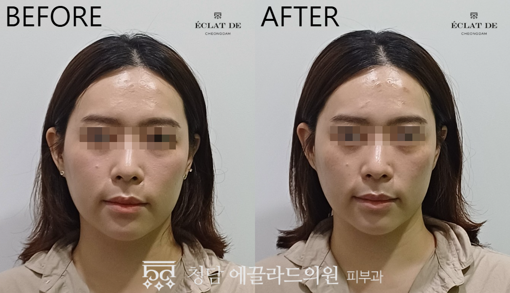 Oligio X 300 shots  – Before & After from Eclat De