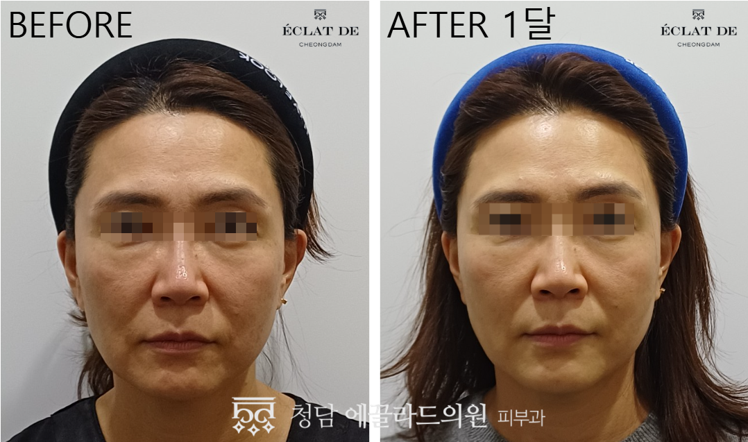 UltraClear- Before & After from Eclat De