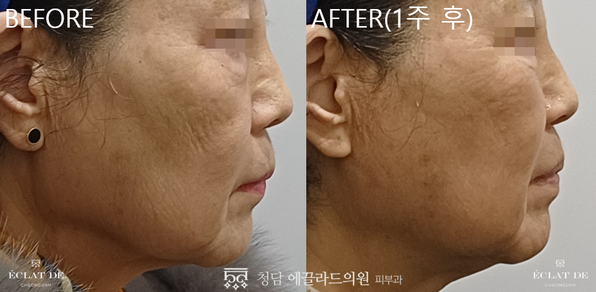 UltraClear- Before & After from Eclat De