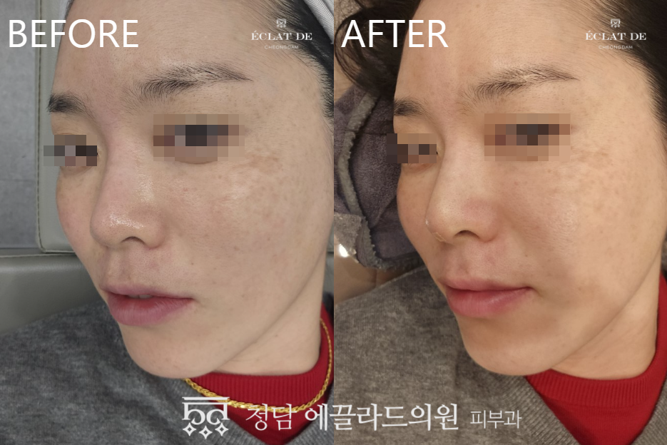 Nose Filler- Before & After from Eclat de