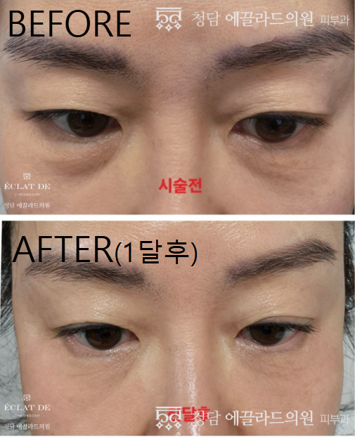 EYE Thermage- Before & After from Eclat De 