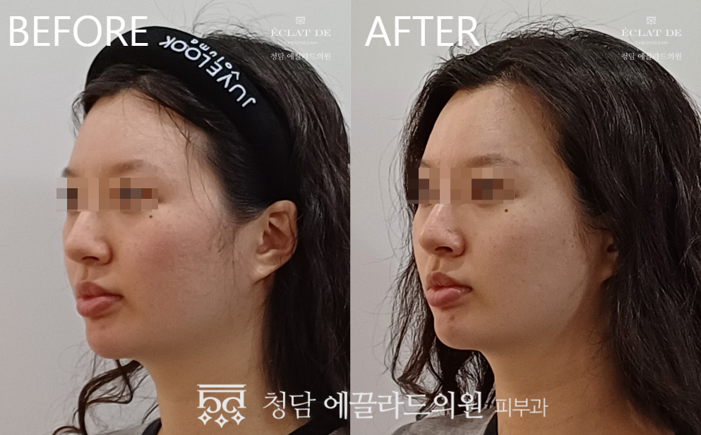 Ultherapy Prime + Titanium Lifting – Before & After from Eclat De