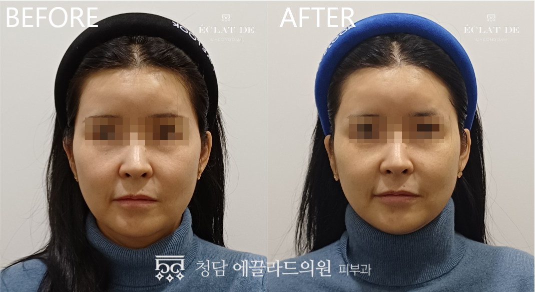 Oligio X 300 shots – Before & After from Eclat De