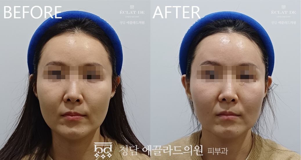 EMFACE- Before & After from Eclat de