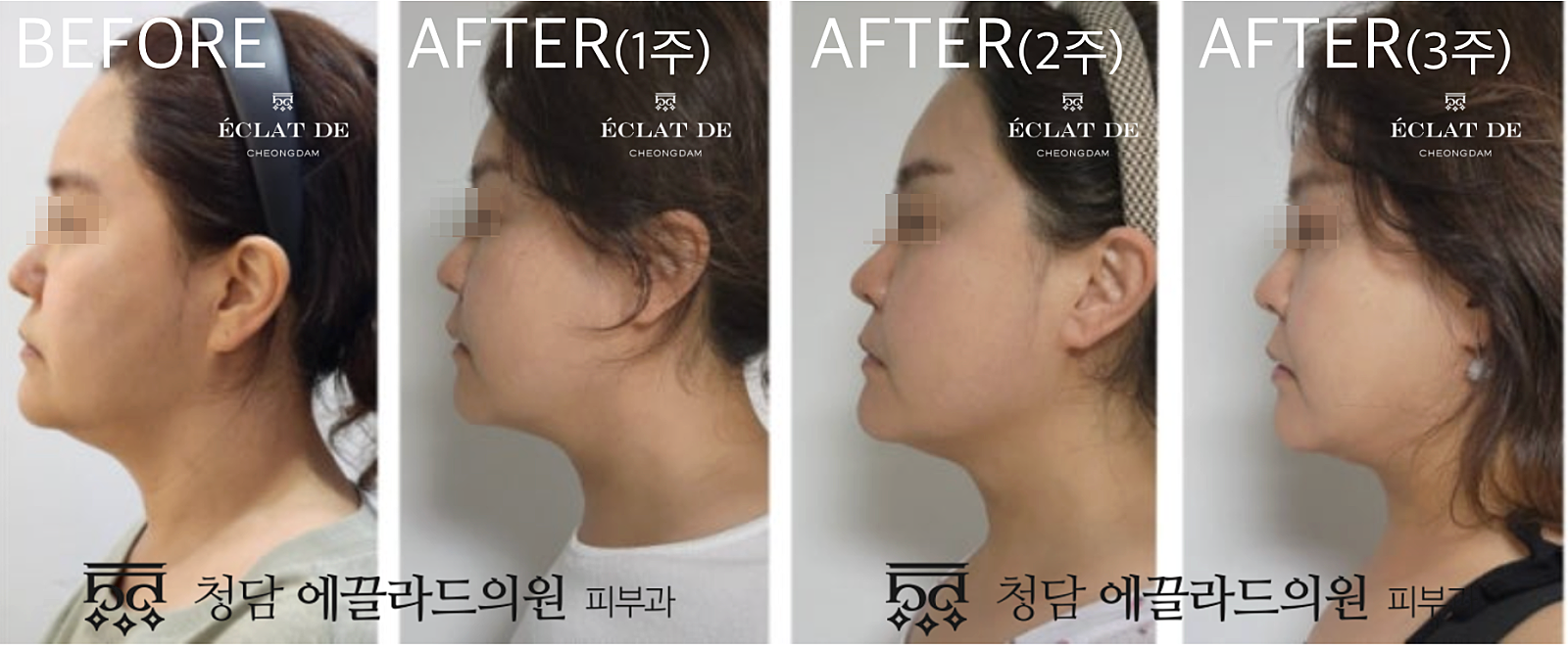 Thermage FLX 300 Shots- Before & After from Eclat De