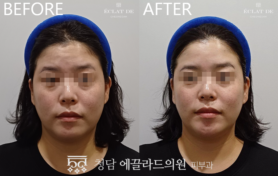 ONDA FACE- Before & After from Eclat de