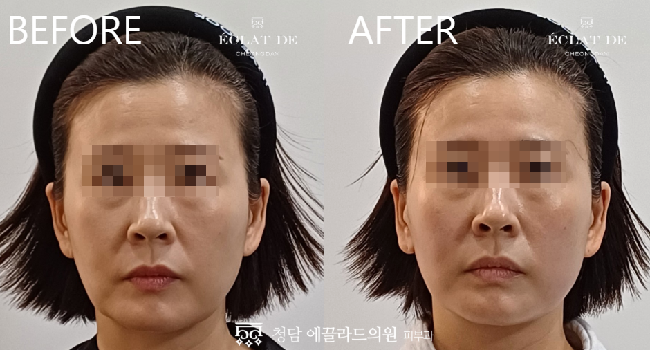 Titanium Lifting – Before & After from Eclat De