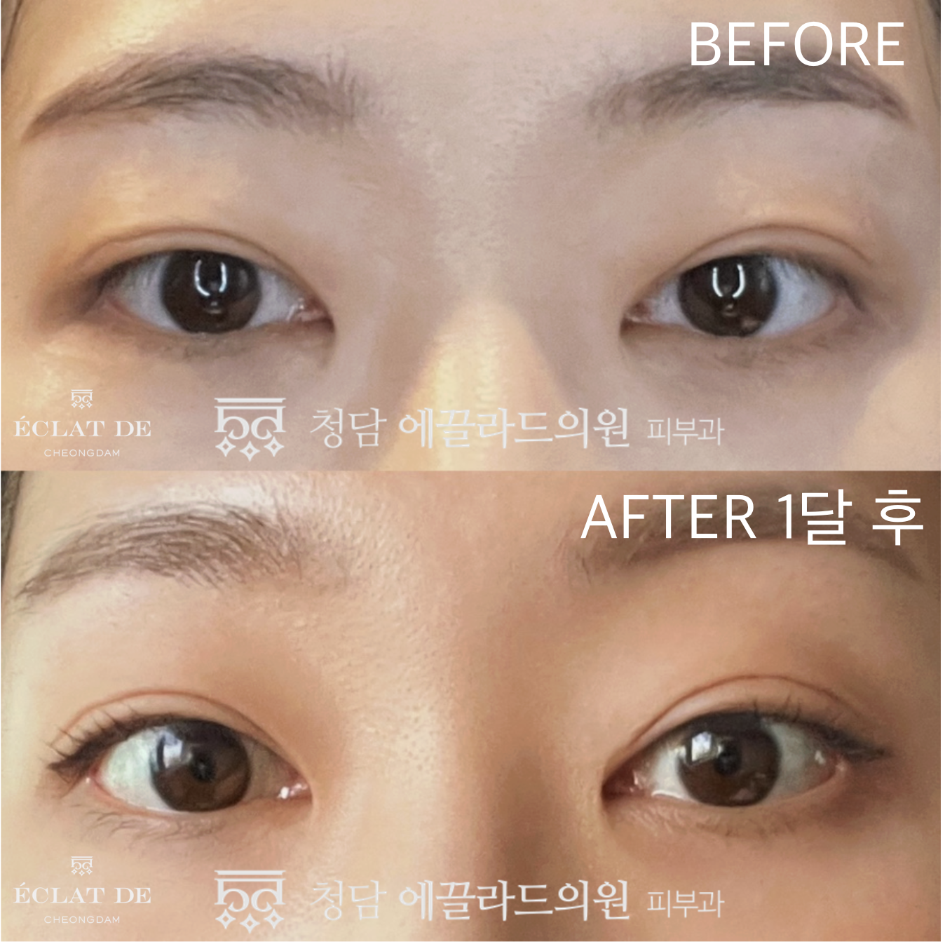 Eye & Forehead Ultherapy – Before & After from Eclat De